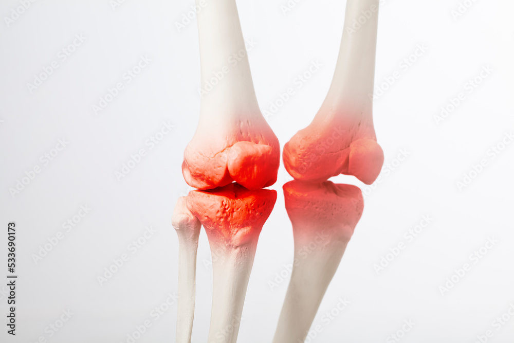 Knee meniscus inflamed, human leg, medically accurate representation of