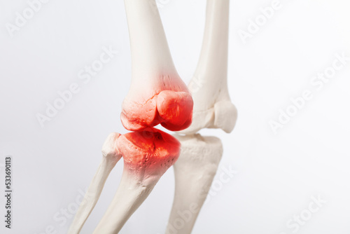 Knee ligament and meniscus, human leg, medically accurate representation of an arthritic knee joint