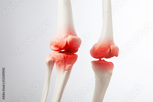 Knee meniscus inflamed, human leg, medically accurate representation of an arthritic knee joint