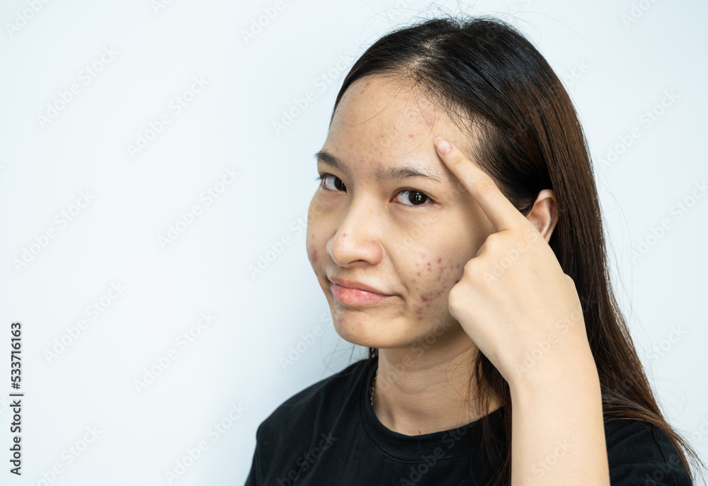 Asian woman pointing to acne problems inflamed on her forehead. Asian woman pointing to acne problems inflamed on her forehead.