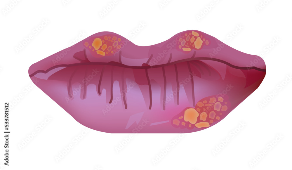 Vecteur Stock Vector Medical Illustration Of Herpes Labialis Cold vecteur-stock-vector-medical-illustration-of-herpes-labialis-cold
