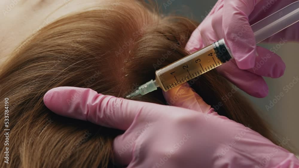 Plasma treatment, plasmolifting or PRP method point the introduction of the patient's own plasma enriched with platelets, in the problem areas of the skin.