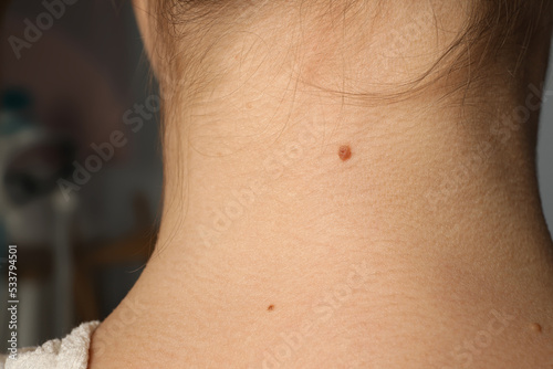 Closeup view of woman s neck with birthmarks