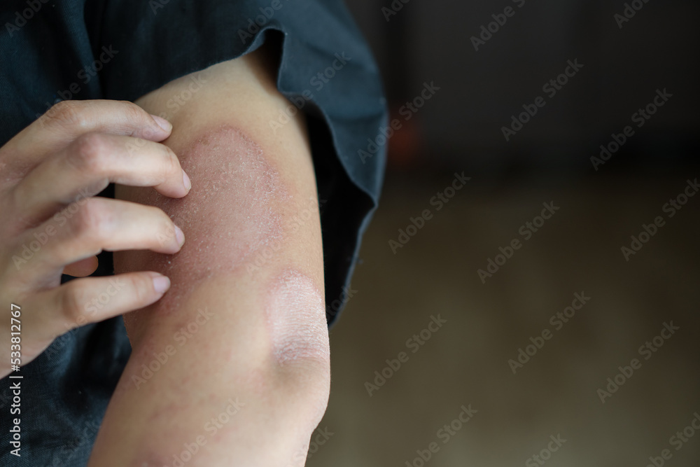 Fototapeta premium hand scratching arm skin for relieve itching and allergic