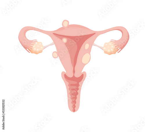 Female uterus with different types of fibroids, treatment of benign tumors by modern medicine. Flat isolated vector anatomical illustration, female health care, gynecology. photo