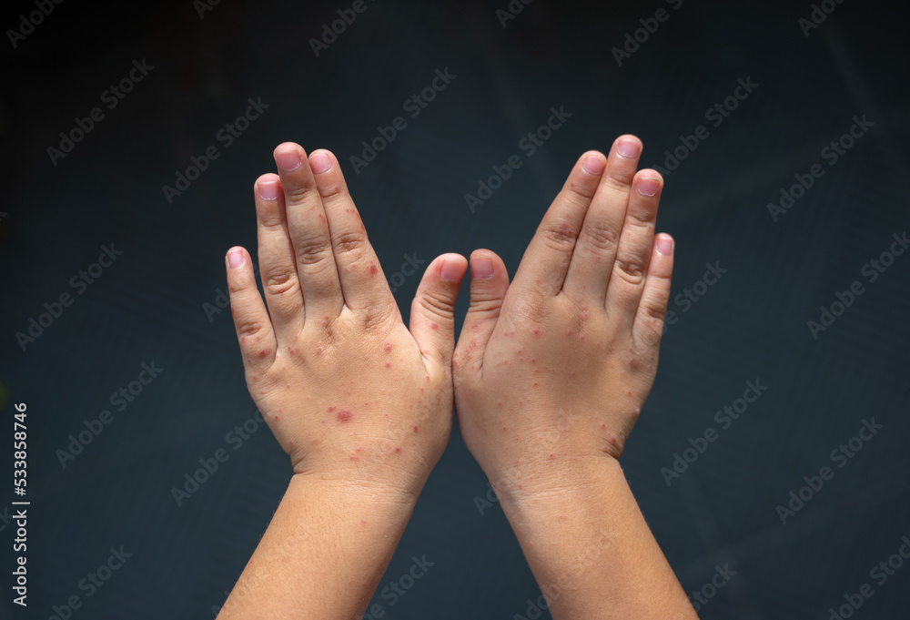Rash on the hands of the Hand foot and mouth disease. Handfootand