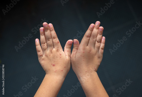 Rash on the hands of the Hand foot and mouth disease. Hand-foot-and-mouth disease is most commonly caused by a coxsackievirus and Enterovirus. photo