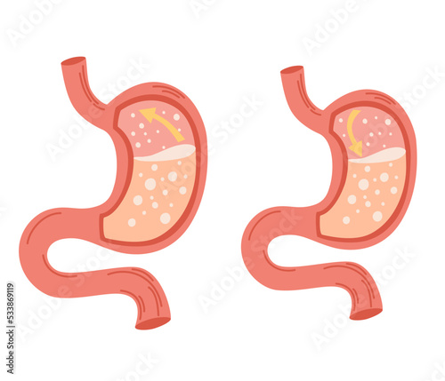 Human stomach set. Gastroesophageal reflux disease concept. Unhealthy stomach concept. Heartburn, illness, discomfort, pain. Flat vector illustration isolated on white