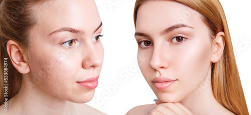 Young woman before and after acne treatment and make-up.