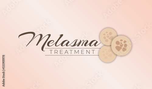 Melasma Treatment Banner Background Vector Design