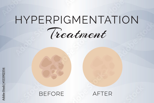 Hyperpigmentation Treatment Before and After Illustration Design photo