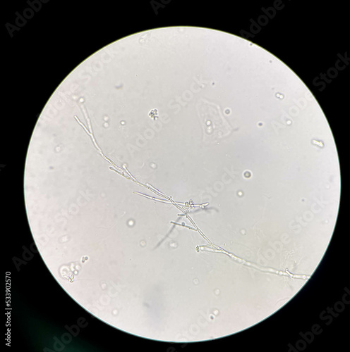 Budding yeast cells with pseudohyphae in urine sample. photo