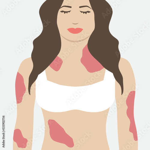 Woman with Psoriasis Red Skin Illness Illustration Design