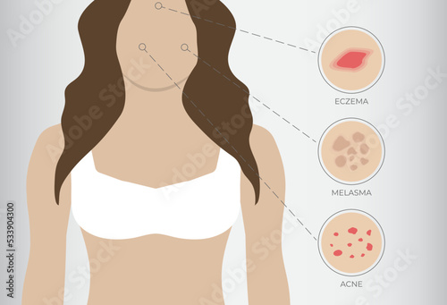 Illustration of Eczema, Acne and Melasma with Woman Background