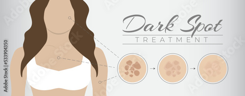Dark Spot Treatment Illustration Design with Woman and Melasma Skin Pigmentation photo