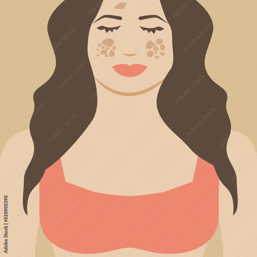 Girl or Woman with Melasma. Pigmentation Spots Illustration Design