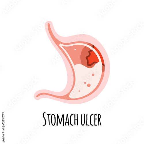 The stomach of a person with an ulcer. Gastroenterology. Vector illustration in a flat style.