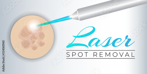 Laser Spot Removal Background Illustration