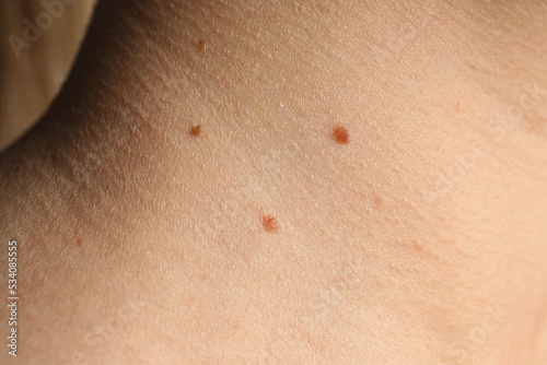 Closeup view of woman s body with birthmarks