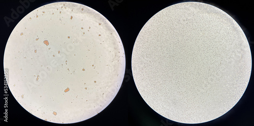 Foto Left Red blood cell agglutination Crossmatching Incompatible donor