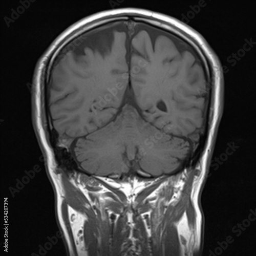 Foto normal T1 coronal plane  brain Magnetic resonance imaging (MRI)