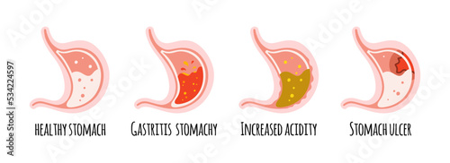 The stomach of a healthy person, with ulcers, gastritis, acidity. Gastroenterology. Vector illustration in a flat style.
