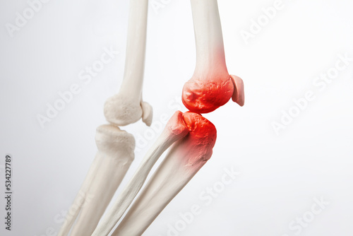 Knee meniscus inflamed, human leg, medically accurate representation of an arthritic knee joint