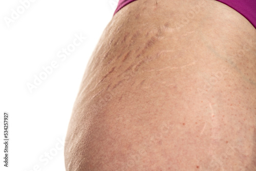 Female hip with stretch marks sensitive problematic skin on a white