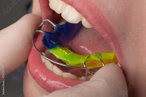 Schilderij op canvas Plate for the lower teeth, orthodontic and plate for the teeth of the lower jaw