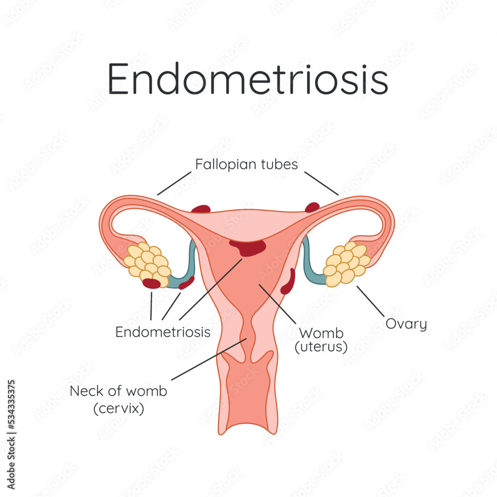 Endometriosis. The appearance of the disease endometriosis. Endometrium ...