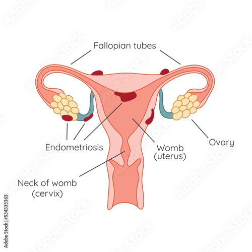 Endometriosis. The appearance of the disease endometriosis. Endometrium. Infographic