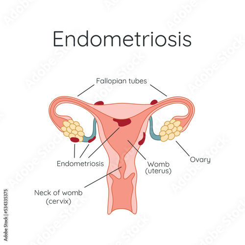 Endometriosis. The appearance of the disease endometriosis. Endometrium. Infographic