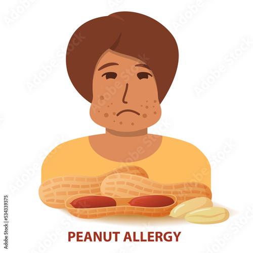Nut allergy symptoms problem .Swollen man character.Allergic reaction to peanuts girl.Flat illustration vector.Isolated on a white background.