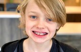 a young child wearing braces - orthodontics on teeth
