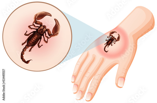Scorpion bites sting on skin