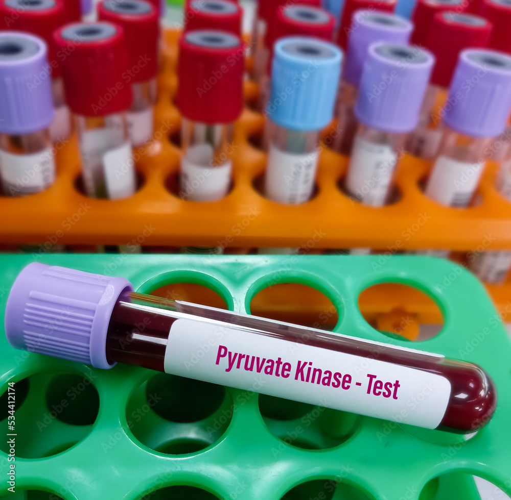 Blood samples for Pyruvate Kinase test for pyruvate kinase deficiency