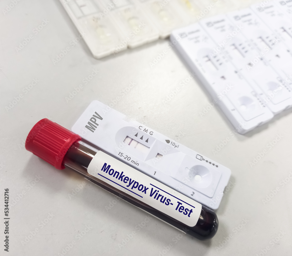Blood sample tube with rapid test kit for Monkeypox virus test. It is