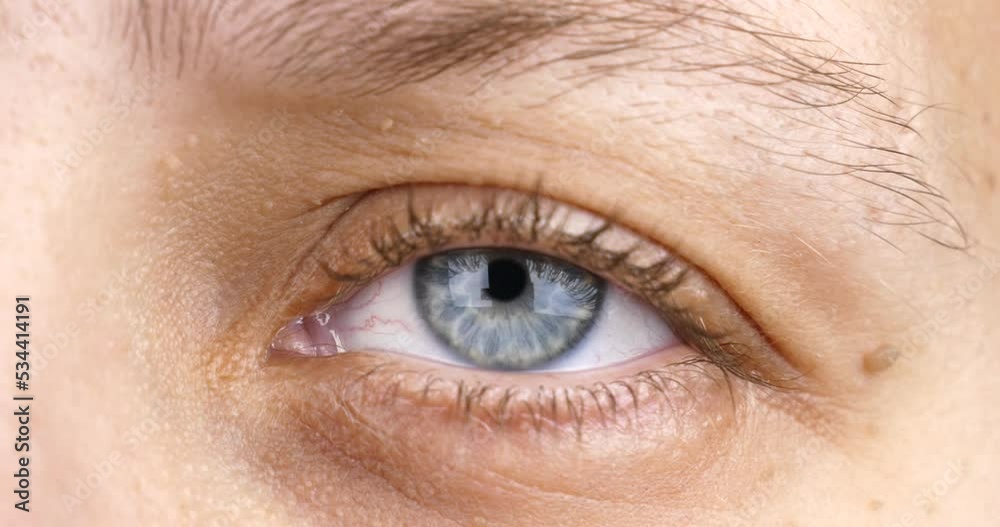 female eye diagnosed with keratoconus corneal thinning. High quality 4k footage female eye diagnosed with keratoconus corneal thinning. High quality 4k footage