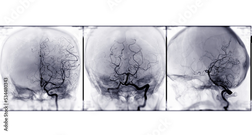 Collection of Cerebral angiography 3