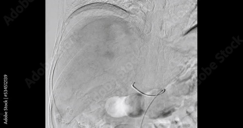 TOCE or Transcatheter Oily Chemo Embolization is a procedure that allows a dose of chemotherapy drugs to be administered directly to Liver tumor or HCC.