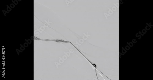 Angiogram balloon dialysis catheter inflated at Arteriovenous (AV) graft for dilated vessel from patient hemodialysis in end stage renal disease (ESRD).	 photo