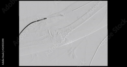 Angiogram balloon dialysis catheter inflated at Arteriovenous (AV) graft for dilated vessel from patient hemodialysis in end stage renal disease (ESRD).	 photo