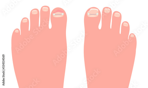 Toes on the foots with a titanium staple on the thumb for correction of the shape of the toenail cartoon vector illustration isolated on a white background. photo