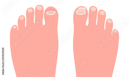 Toes on the foots with a titanium staple on the thumb for correction of the shape of the toenail cartoon vector illustration isolated on a white background.