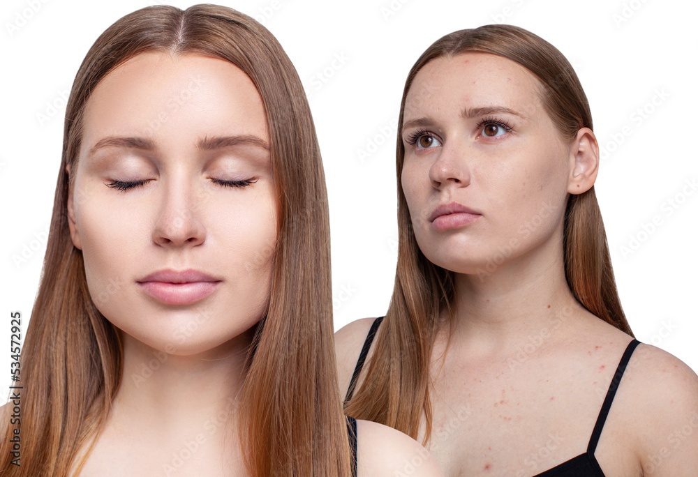 Young woman before and after acne treatment and retouch. Young woman before and after acne treatment and retouch.