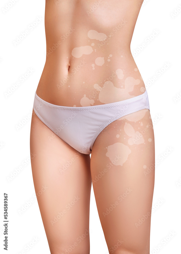 Female body with pale white vitiligo patches. Female body with pale white vitiligo patches.