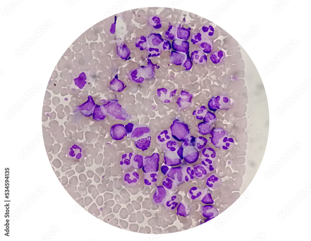 Chronic Myelogenous Leukemia Cml Also Known As Chronic Myeloid Chronic Myelogenous Leukemia Cml Also Known As Chronic Myeloid