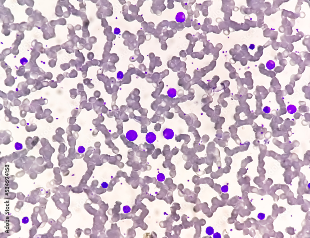 chronic-myelogenous-leukemia-cml-also-known-as-chronic-myeloid