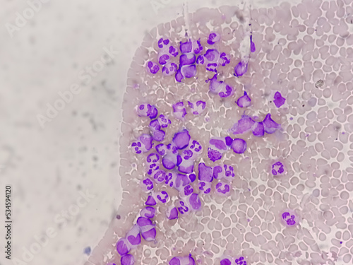 Chronic myelogenous leukemia (CML), also known as chronic myeloid leukemia, is a cancer of the white blood cells. chronic granulocytic leukemia 