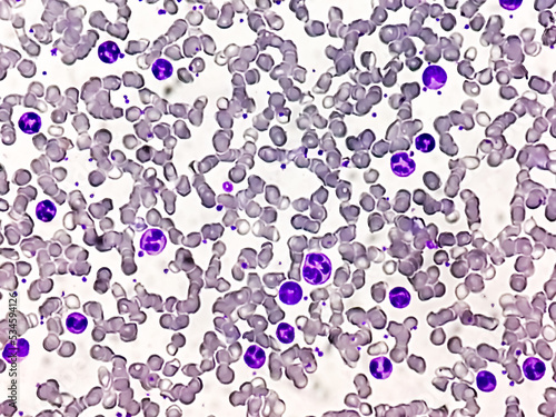 Chronic myelogenous leukemia (CML), also known as chronic myeloid leukemia, is a cancer of the white blood cells. chronic granulocytic leukemia  photo